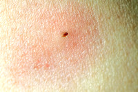Bug bite on Karl 060714